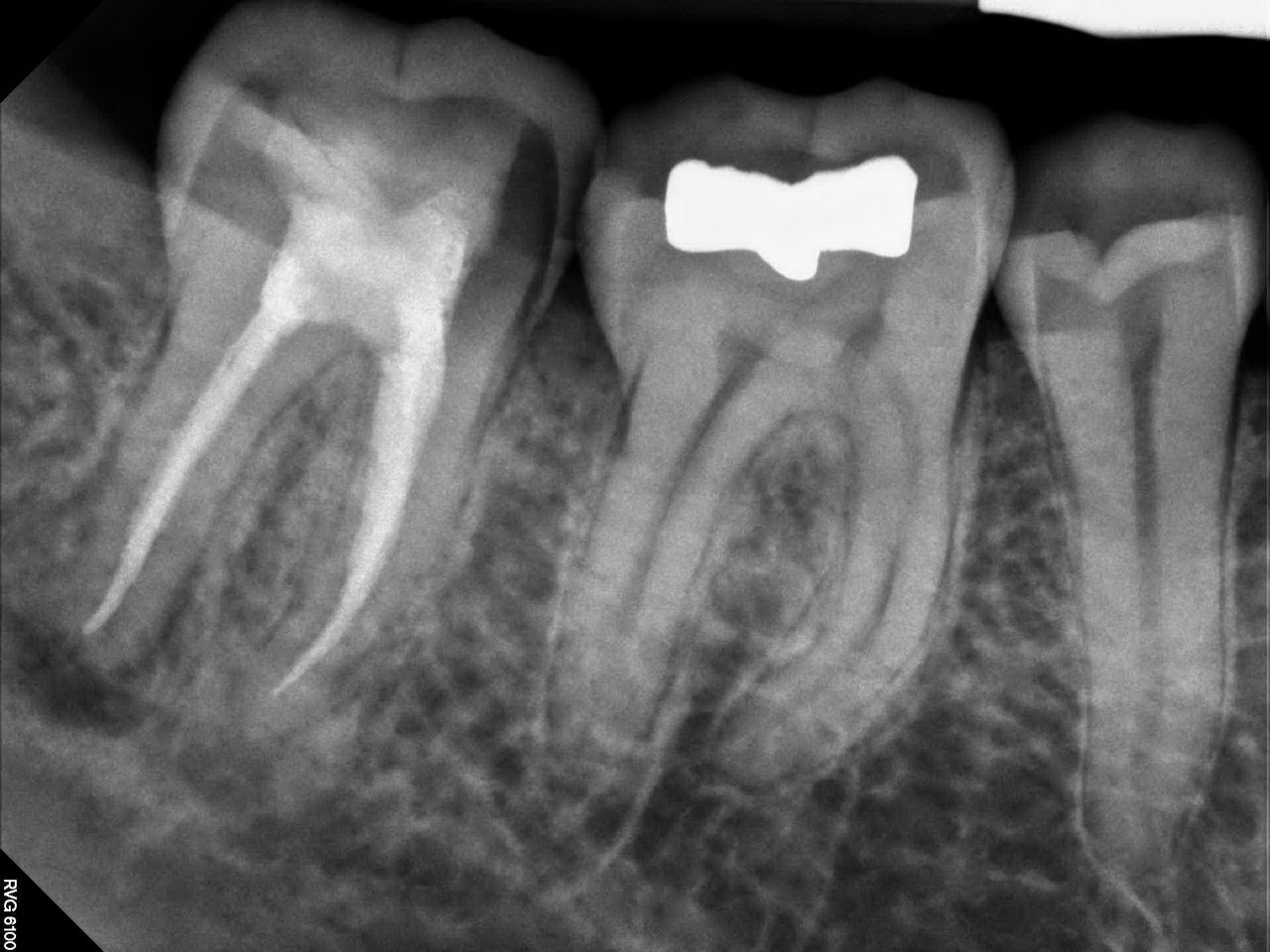 Diş Röntgeni