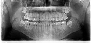 20 yaş dişlerini gösteren panoramik röntgen filmi