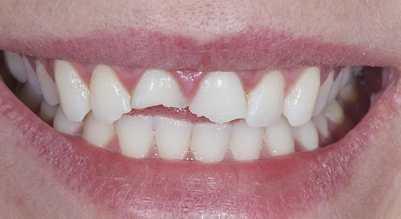 Kırılan Dişler Nasıl Tedavi Edilebilir?