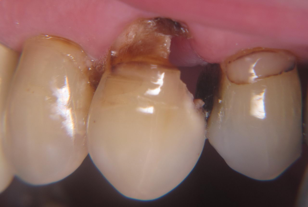 Diş Çürüğü Nedir?