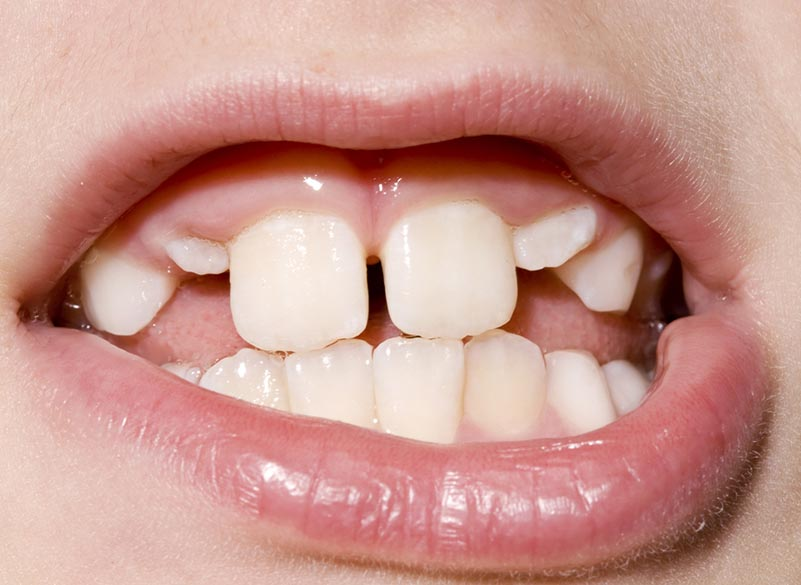 Çocuklarda Ağız ve Diş Sağlığı Neden Önemlidir?