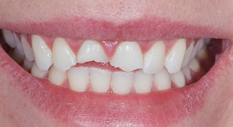 Kırık Dişlerde Acil Rehber