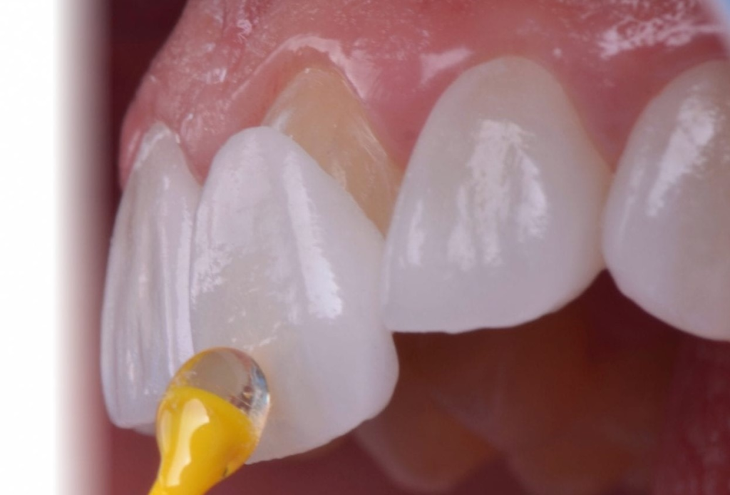 Lamine Diş Kaplama,Yaprak Porselen, yaprak porselen