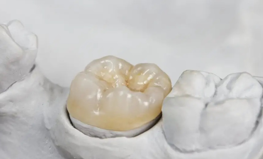 İnley ve Onley Dolgular Nedir?