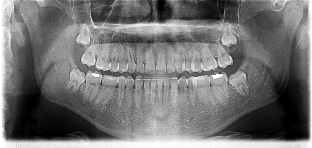 Yirmi Yaş Dişleri Neden Çekilir?